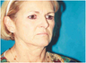 Facelift