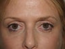 Before and After upper and lower lid Blepharoplasty
