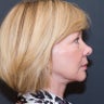 Facelift + Neck Lift + Eyelid Lift (Blepharoplasty)