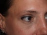 Before and After Lower Lid Blepharoplasty