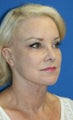 Facelift with Extended Necklift, Browlift, Peri-orbital Fat Transfer, and Skin Pinch