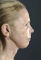 Facelift