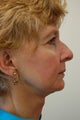 Facelift
