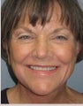 Facelift