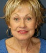 Facelift