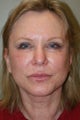 Facelift, Liposuction of the Neck, Upper Eyelid Blepharoplasty, Juvederm injections into the upper and lower lips, tip rhinopla