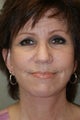 facelift with Liposuction of the Neck