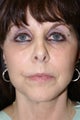 Facelift, Liposuction of the Neck, Facial Peel