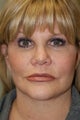 Facelift, Liposuction of the Neck, Upper Eyelid Lift