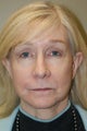 Facelift, Liposuction of the Neck, Browlift, DOT Laser Therapy
