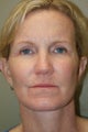 Facelift, Upper Eyelid Biepharoplasty, DOT Laser Therapy