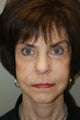 Facelift, Liposuctin of the Neck, Browlift, Upper and Lower Eyelid Biepharoplasty, Fat Grafting to Mid Face Regions, DOT