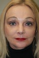 Facelift, Upper and Lower Lip Augmentation, Browlift, DOT Laser Therapy