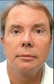 Facelift; Upper and lower eyelid (blepharoplasty) surgery