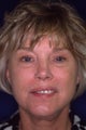 Facelift