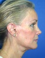 Facelift