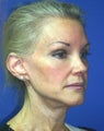 Facelift