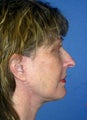 Facelift