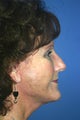 Facelift