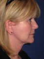 Facelift