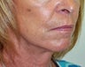 Facelift