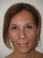 Before and just 2months after extended midfacelift and browlift