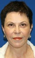 Facelift with Extended Necklift, Browlift, Fat Transfer, Upper Blepharoplasty, and Skin Pinch