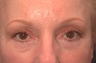 Composite facelift, midface lift, upper and lower blepharoplasty, browlift and ptosis repair