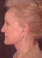 Composite facelift, midface lift, upper and lower blepharoplasty, browlift and ptosis repair