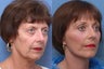 Facelift