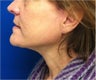 Facelift