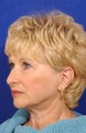 Face Lift, Neck Lift, and Upper Blepharoplasty