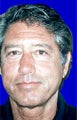 Facelift, necklift, superficial cheeklift, upper blepharoplasty