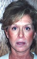 Face-neck Lift, SMAS elevation, LiveFill, Cheek Lift, and Upper Blepharoplasty