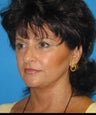 Facelift