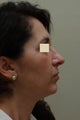 Facelift
