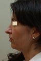 Face Lift (side view)