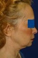 Facelift