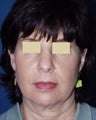 Facelift