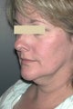Facelift