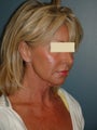 Facelift