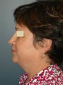 Facelift