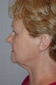 Facelift