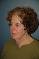 Facelift