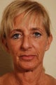 Stem Cell Enriched Facial Rejuvenation