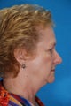 Face Lift with upper and lower blepharoplasty