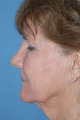 Facelift