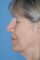 Facelift