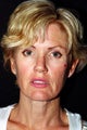 Facelift