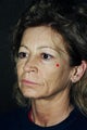 Facelift